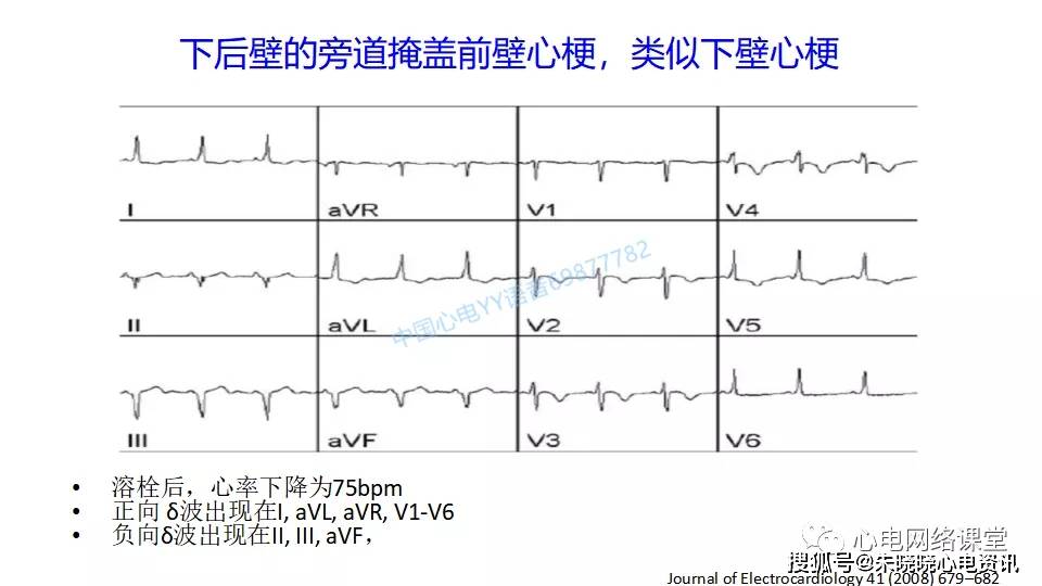 不典型心肌梗死的心电图改变