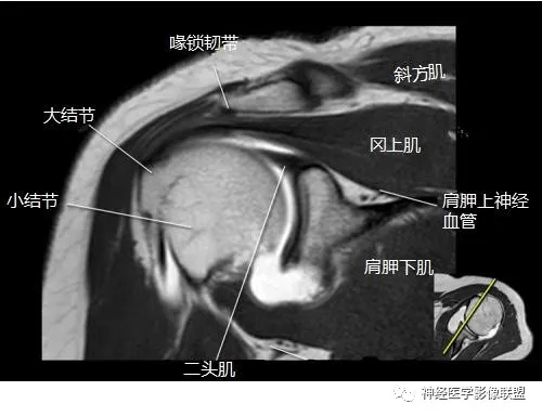 肩关节磁共振断层解剖