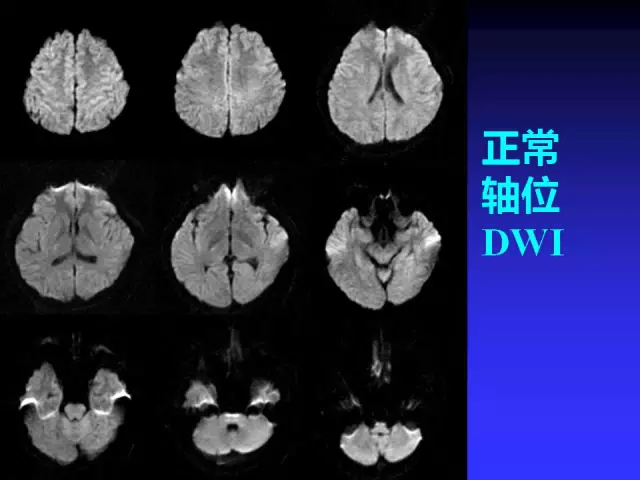 mr入门 | 头颅mri读片知识,需掌握!