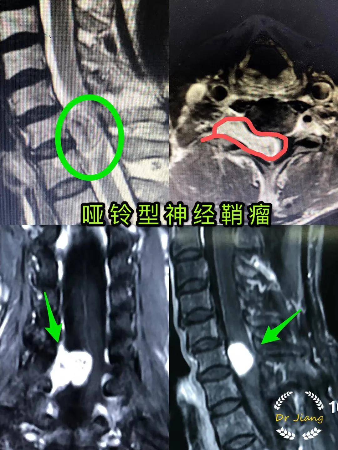 病理诊断:胸5-6椎管内神经鞘瘤.