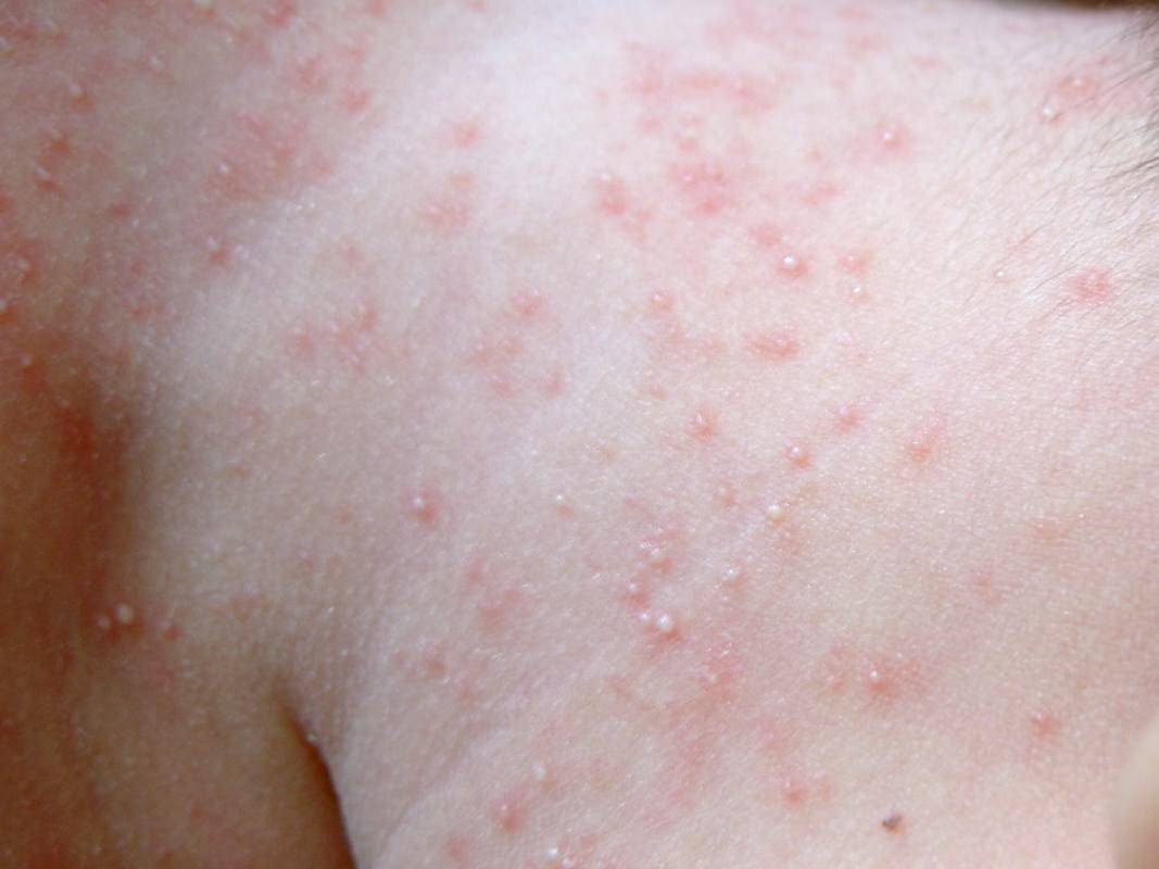 4张高清图片，告诉你湿疹与热疹到底有何区别 - 柚喜
