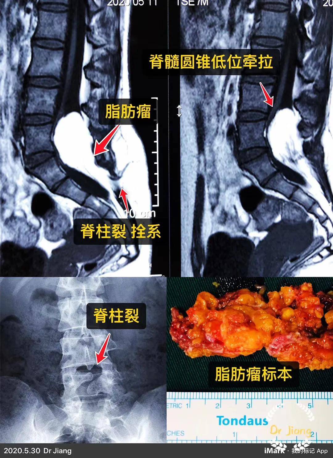 女性,17岁.病理结果: 脂肪瘤型脊髓拴系综合征.