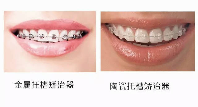 整齐的牙齿是怎样的 e3f8c90879d7424abd2f4fca9a4b0b14.jpeg