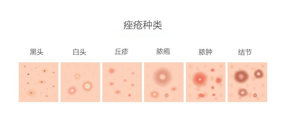 伊的家说护肤:痘痘肌9种防御指南