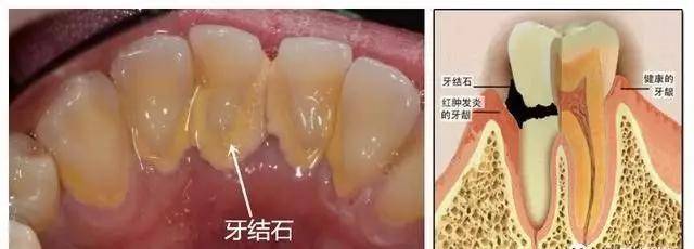 震惊不长牙结石就不是地球人吗