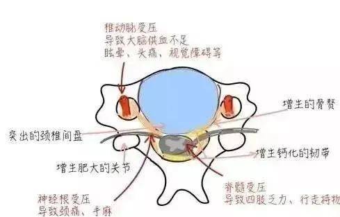 原因 由于颈椎退行性变,骨质增生刺激或者压迫了颈部交感神经引起的.