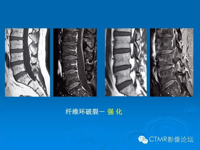 椎间盘退变某些mr征象的再认识