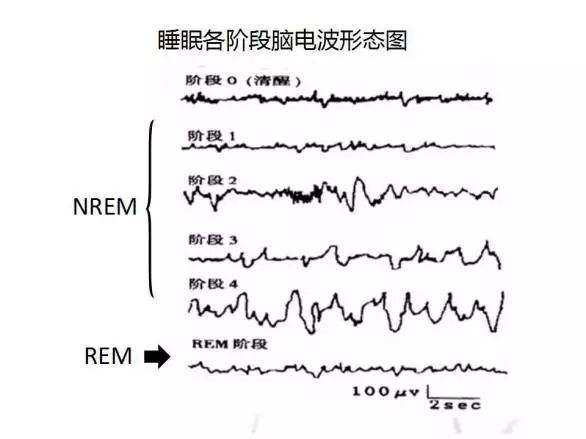 期: 阶段1:在睡眠开始眼球会缓慢运动,此阶段的人仍然认为自己是清醒