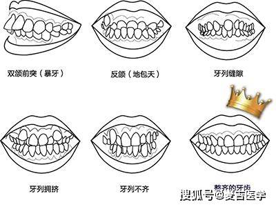 由于牙齿移位,原来排列整齐的牙齿变稀,上前牙向外突出,牙齿之间产生