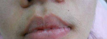 女生应该怎么永久去唇毛?有没有自然安全的好方法?