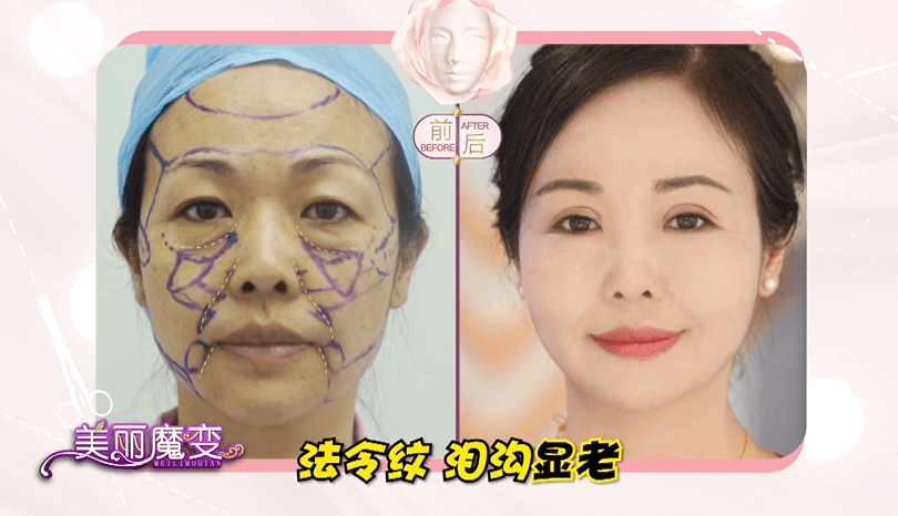 怎么快速瘦脸不垮脸 97b796579b014f42aaba961f9c14c3e9.png