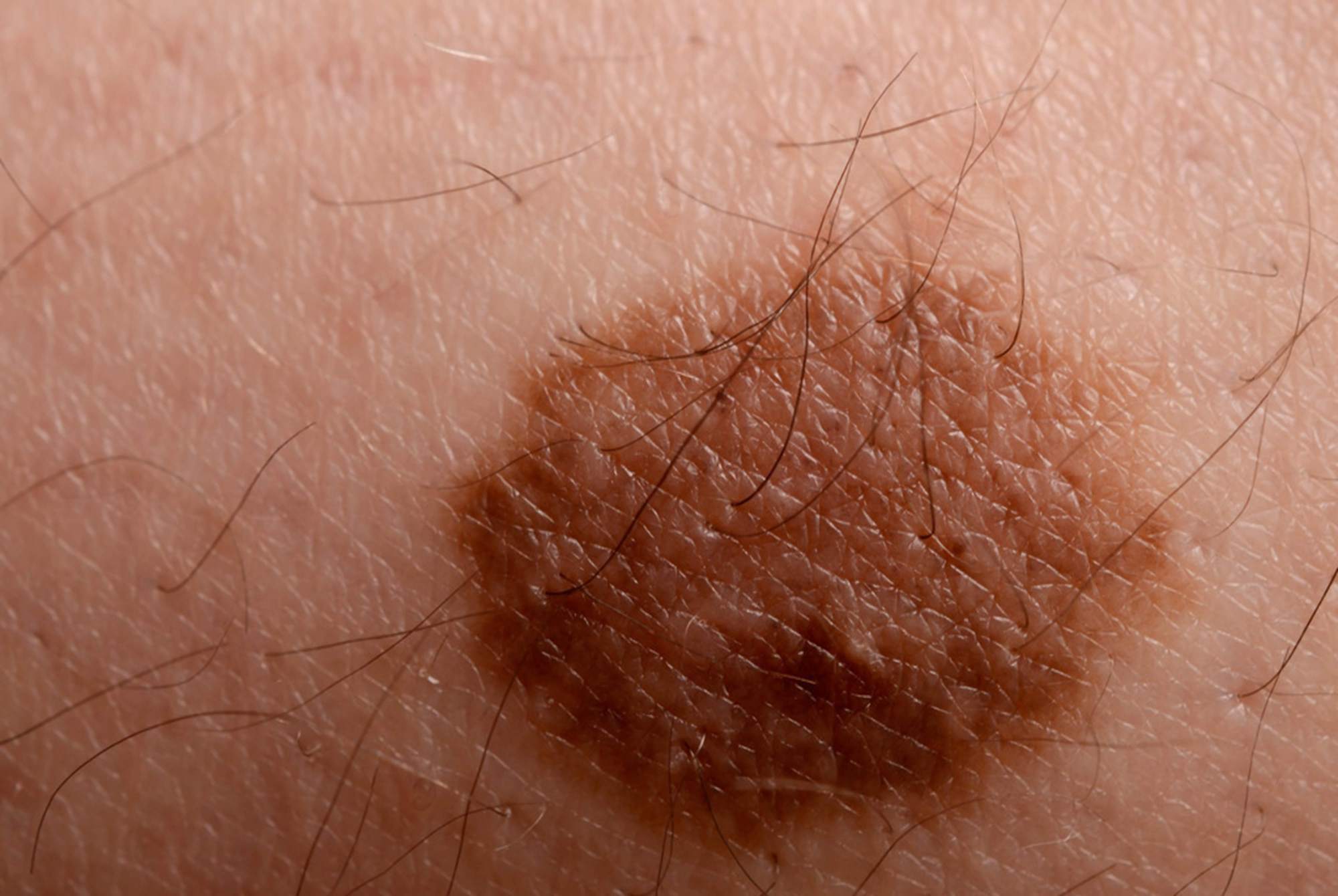 身上有胎记，应该如何闭坑治疗？