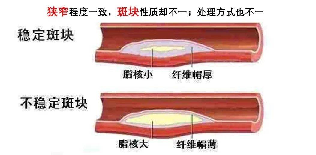 颈动脉狭窄和颈动脉斑块,你分清楚了吗?_程度