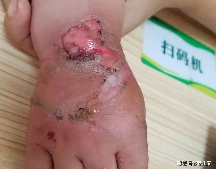 宝宝|只因手上戴个它…这东西再好,也别让娃戴了!11个月宝宝手肘脱位