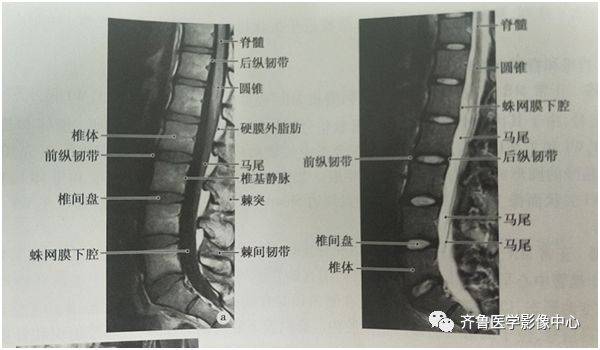影像基础:正常脊椎,脊髓表现:x线,ct,mri