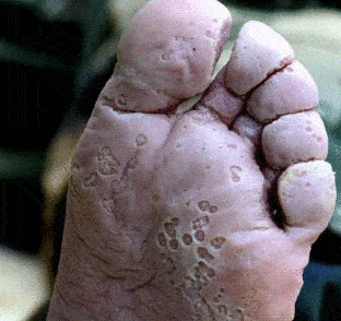 脚趾间的小水泡伴着瘙痒,脱皮,溃烂,如此下来,还会伴有酸臭的脚丫子