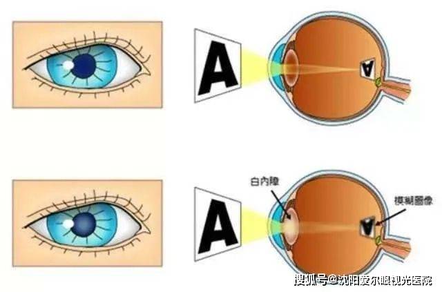 如何让眼睛视力不下降 9aa12751d91c4aa58c4f4193c71ba977.jpeg