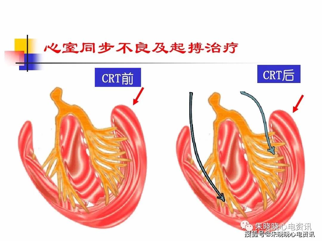 心脏起搏 8a99608e82c24bb69c0e7767f1586c55.jpeg