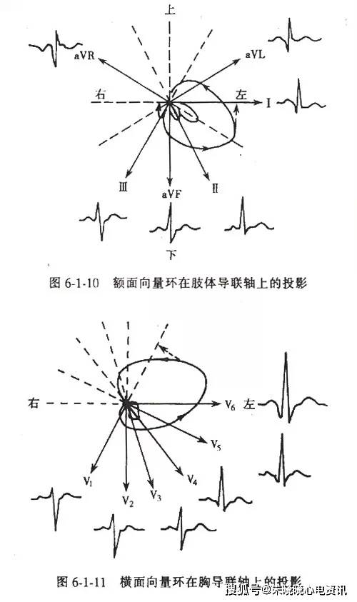 v2~v5(v1(v6)前壁:v3,v4,v5前间壁:v1,v2,v3(三,心肌梗死的定位诊断