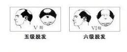 五级脱发前额及头旋部位在整体脱落,中间形成断带,脱发面积大,一次