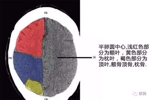 初学者必备:颅脑ct解剖口诀及彩色解剖图