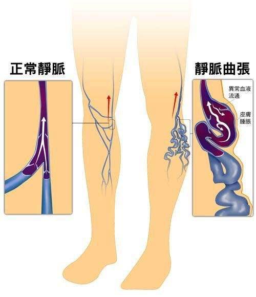 下肢静脉曲张溃疡的中西医结合治疗上海岳阳医院张磊