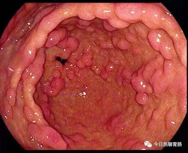 胃息肉需要手术切除吗?医生:久拖不治,危害可能不只是