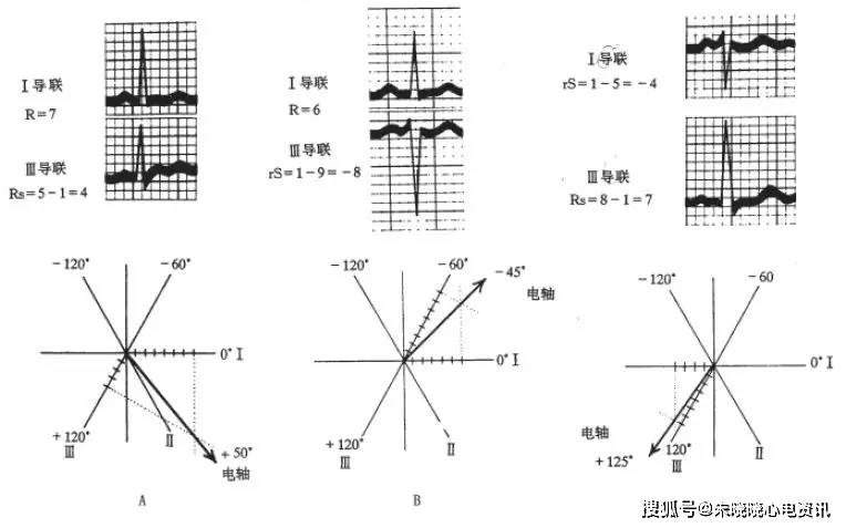 心电轴的测量方法，你掌握了几种？