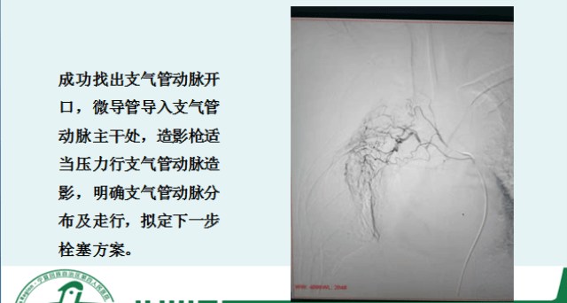 原创宁夏第四人民医院成功为一名大咯血患者实施支气管动脉栓塞术