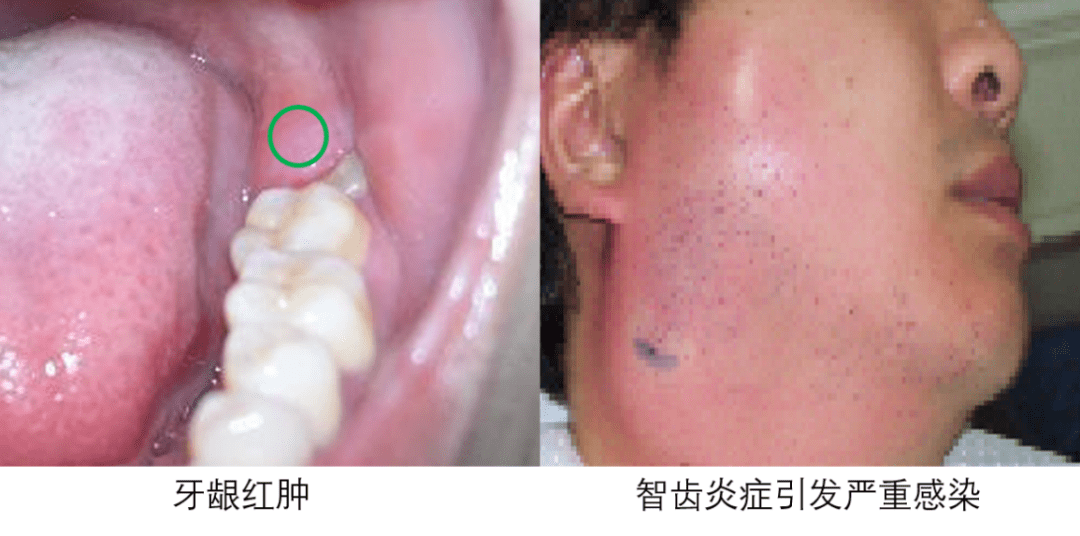 不能自拔的除了爱情还有智齿