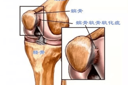 膝盖滑膜炎的治疗周期一般是多久 8815ebec335d4a18b1ff4adbb15b2bb6.png