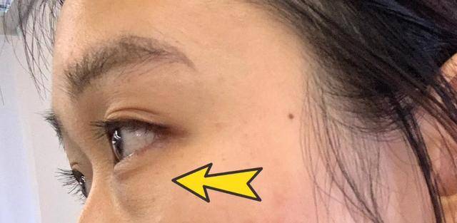 女明星|女明星“眼下增肥”是什么操作？