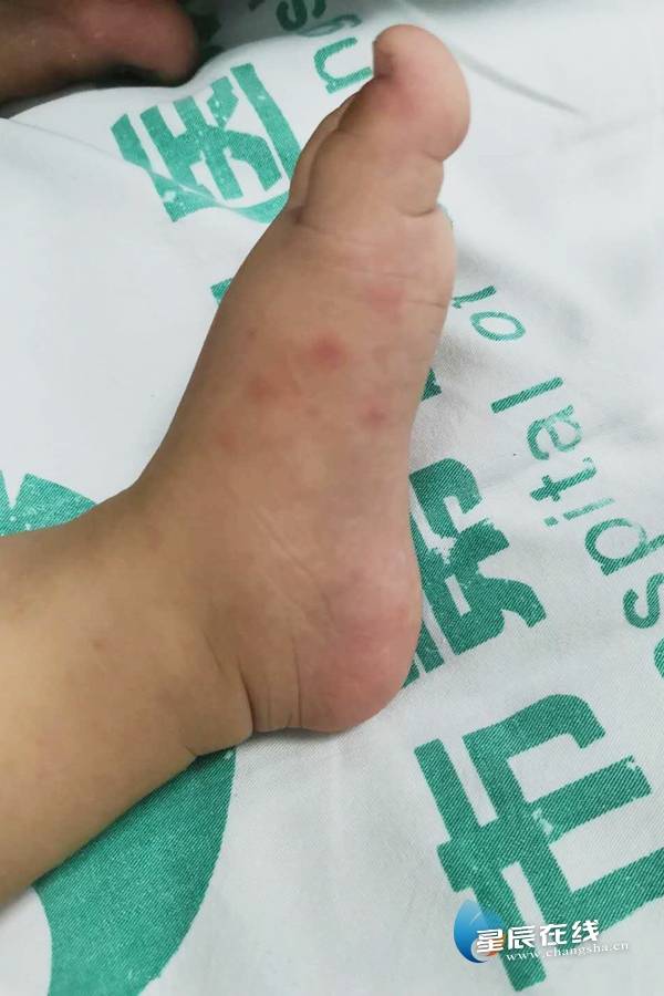 手足口病除了口腔疱疹外,还容易合并手足或臀部的皮疹.