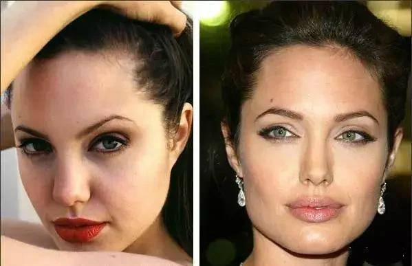 鼻子|别再羡慕欧美立体颜了！朱莉的精致翘鼻是整的，她丰唇一年花16万