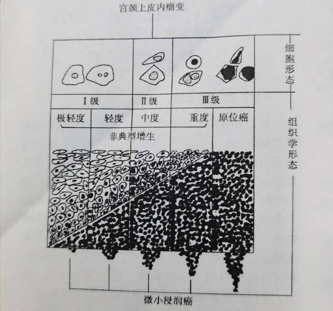 图片来源:《林巧稚妇科肿瘤学》 而宫颈浸润癌相较于原位癌,已经突破