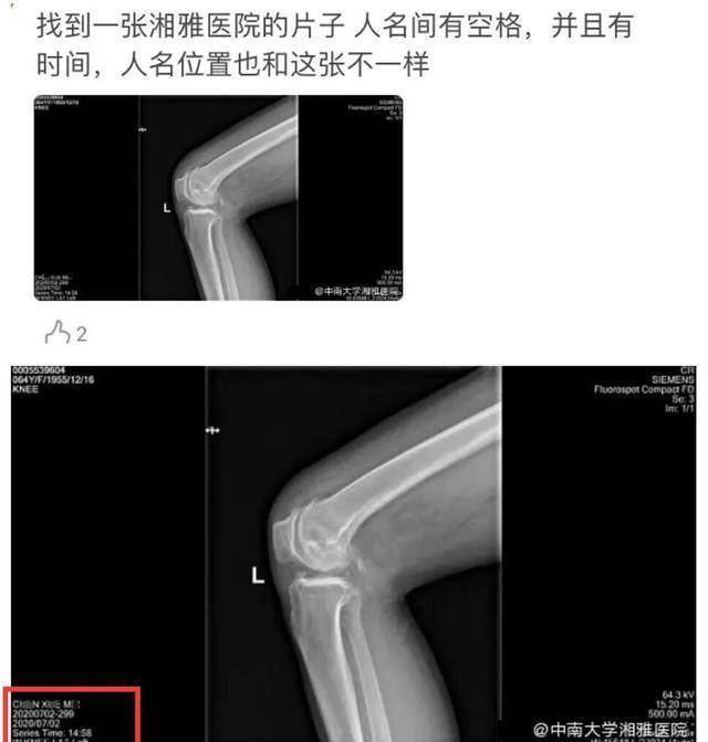 原创万茜骨折是假的?ct照名字前后不同,手臂未见打钢板痕迹引热议
