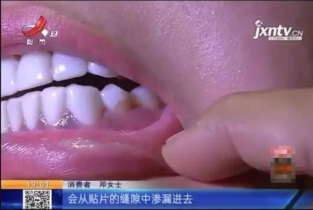 到底要不要做牙齿贴片 a306fe46be454c1a9bbee34b1ebfb74d.jpeg