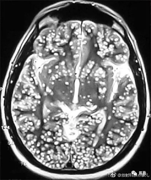 脑囊虫mri图像,个人卫生习惯不好,爱吃生肉的要注意了!05这是个人才.
