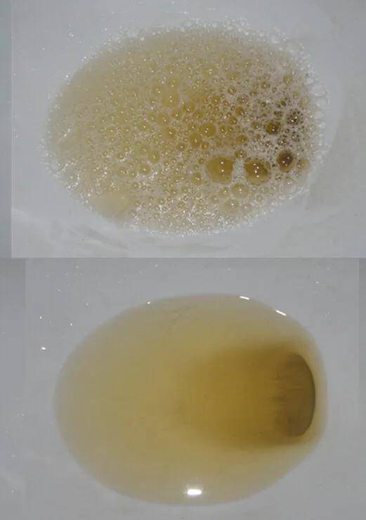 蛋白尿和泡沫正常人的尿液中是没有蛋白的,当尿液中出现大量的蛋白质