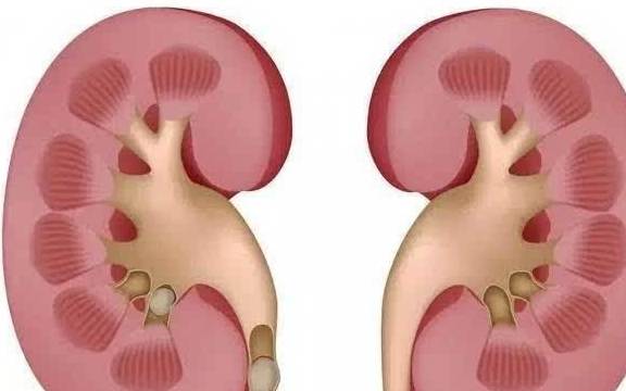 肾结石是怎么引起的啊 91c0454968254fc2a1a19ff272395e6d.jpeg