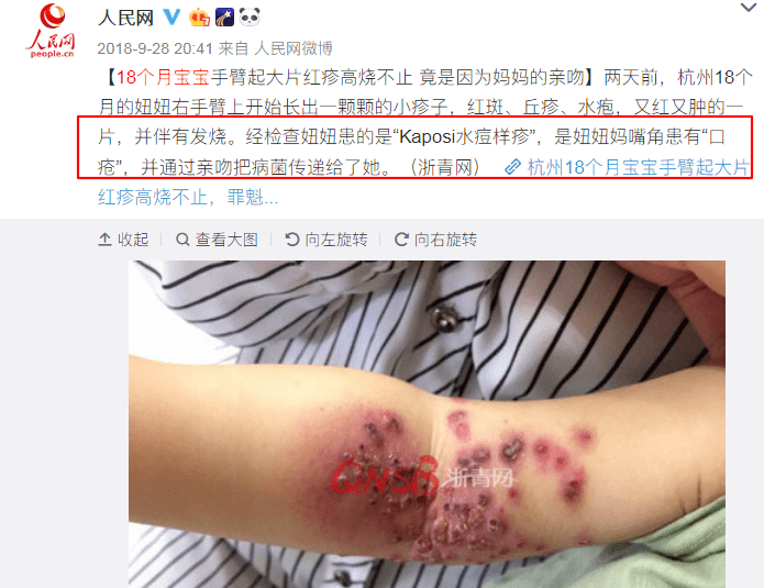 类人|反复高烧致面瘫，这5类人，千万别乱亲孩子！2岁萌娃被吻后