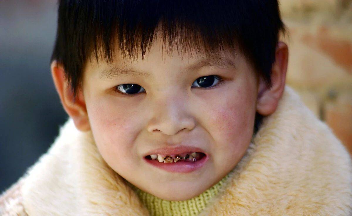 宝宝|孩子小小年纪就蛀牙?宝宝牙齿问题并不简单!