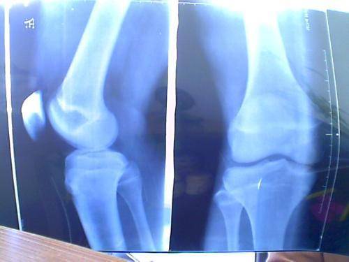 流失|10岁男孩骨骼线闭合.3种饮料加速“钙流失”家长们看一看