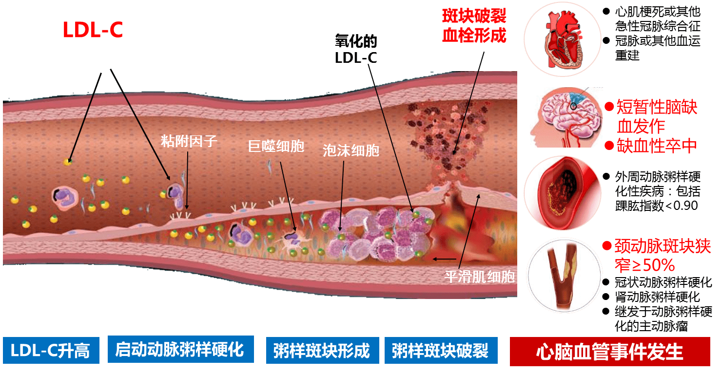 发生动脉粥样硬化后,再也无法逆转?做对3件事,血管减龄增寿