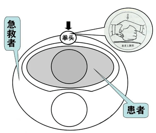 急救|妈妈选择离开,异物卡喉需急救,救护车太慢凌霄喂妹妹核桃卡喉