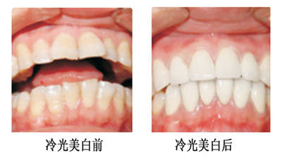 如何变白牙齿 c1e01a3bd2e9416ca4425abe386efb13.jpeg