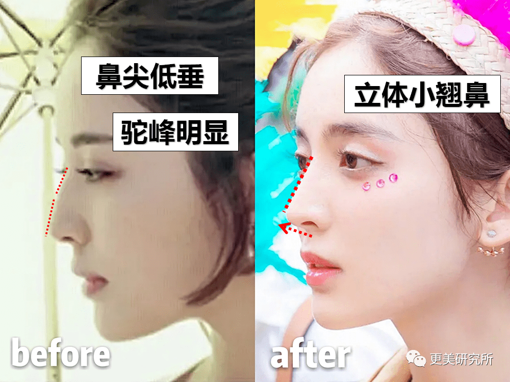 鼻尖|杨幂终于去修复鼻子了…
