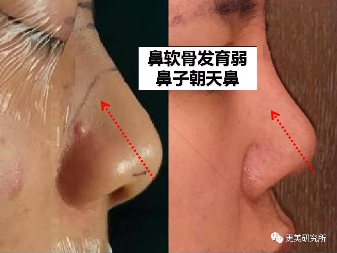 鼻尖|杨幂终于去修复鼻子了…