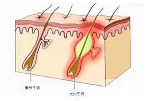 背部毛孔粗大怎么办