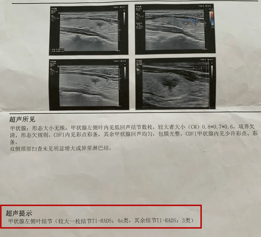 病人拍胸椎ct扫到甲状腺结节,复查就是4a类,下一步该怎么办?